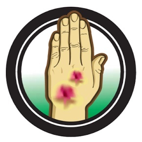 SIXTH PLAGUE OF THE EXODUS-BOILS