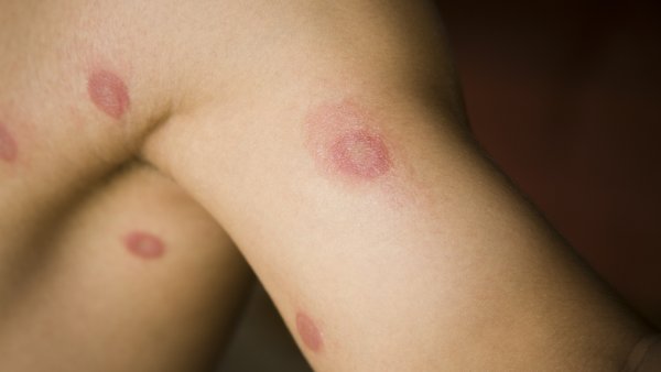 HUMAN RINGWORM © alejandrophotography | iStockPhoto.com