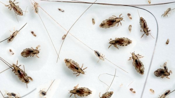 HEAD LOUSE INFESTATION © KevinDyer | iStockPhoto.com