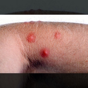 BLEMISHES ON SKIN © Bidouze Sephane | Dreamstime.com